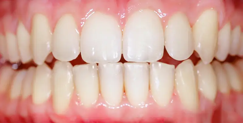 Invisalign Philadelphia Patient After