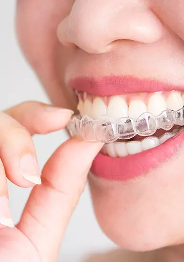 Girl Putting In Invisalign Tray